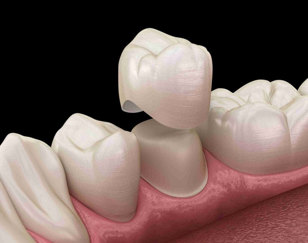 Professional dental crown and bridge restoration at Nova Aghbashian Dental in Glendale, CA 91202, showing a natural-looking smile transformation.