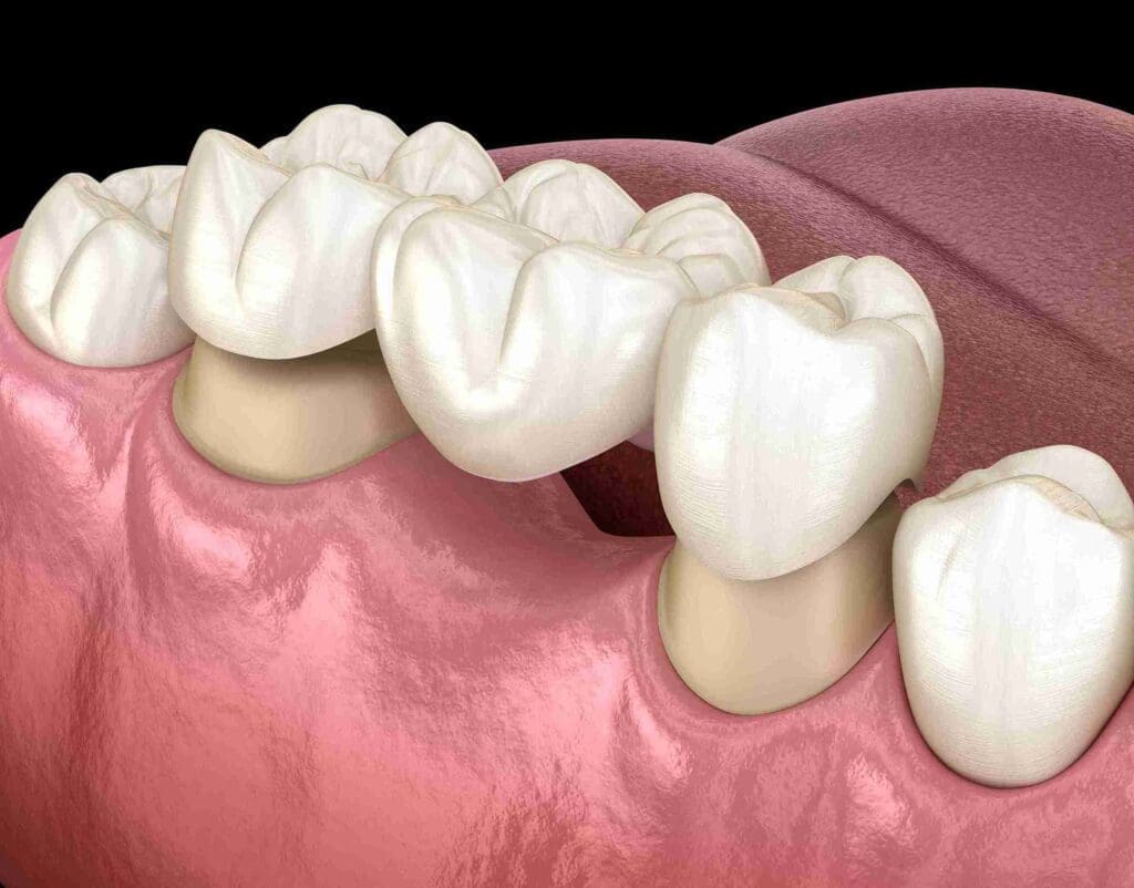 Crown and bridge restoration at Aghbashian Dental