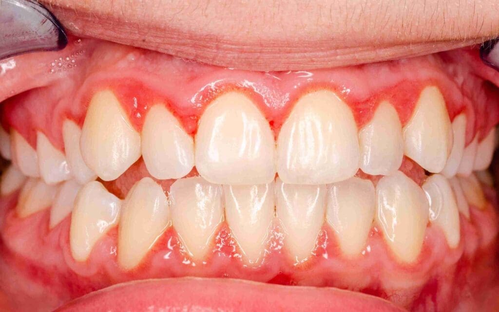 Professional periodontal therapy and gum disease treatment at Aghbashian Dental in Glendale, CA 91202, featuring a comfortable clinical setting for deep cleaning and laser therapy.