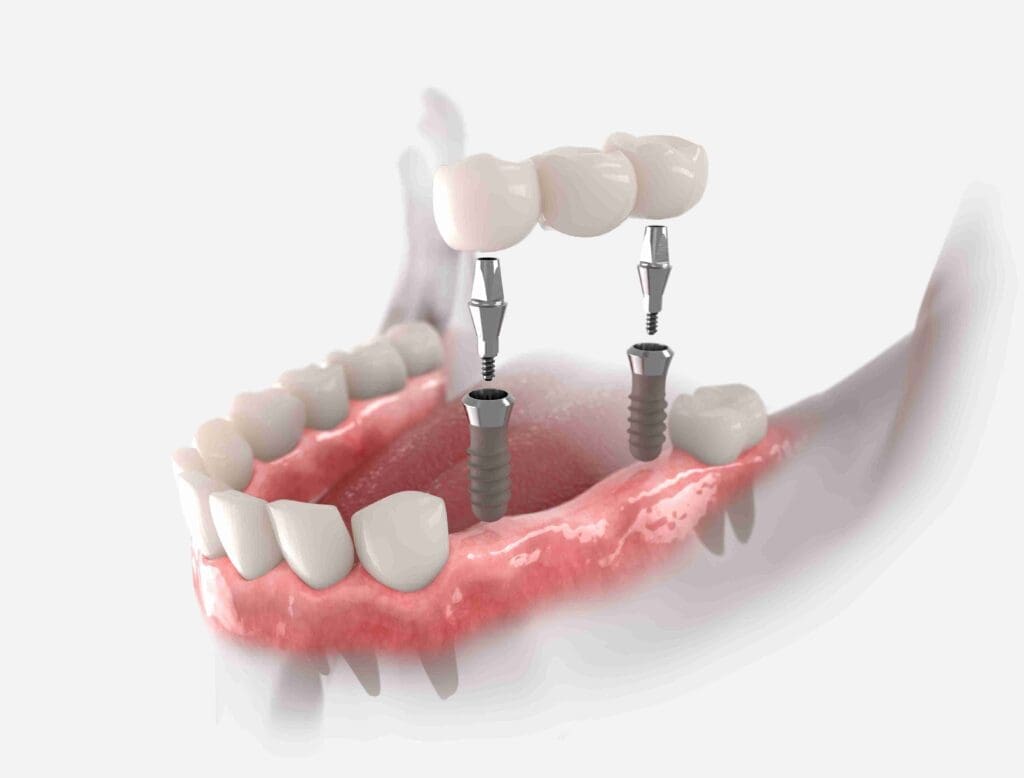 Close-up of a high-quality implant-supported fixed bridge at Aghbashian Dental in Glendale, CA 91202, showing natural-looking teeth and healthy gum integration.