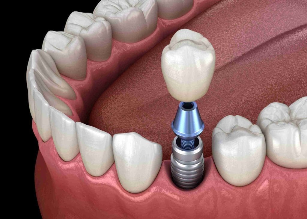A high-definition close-up of a natural-looking dental implant-supported single crown restoration by Dr. Nova Aghbashian at Aghbashian Dental in Glendale, CA 91202.