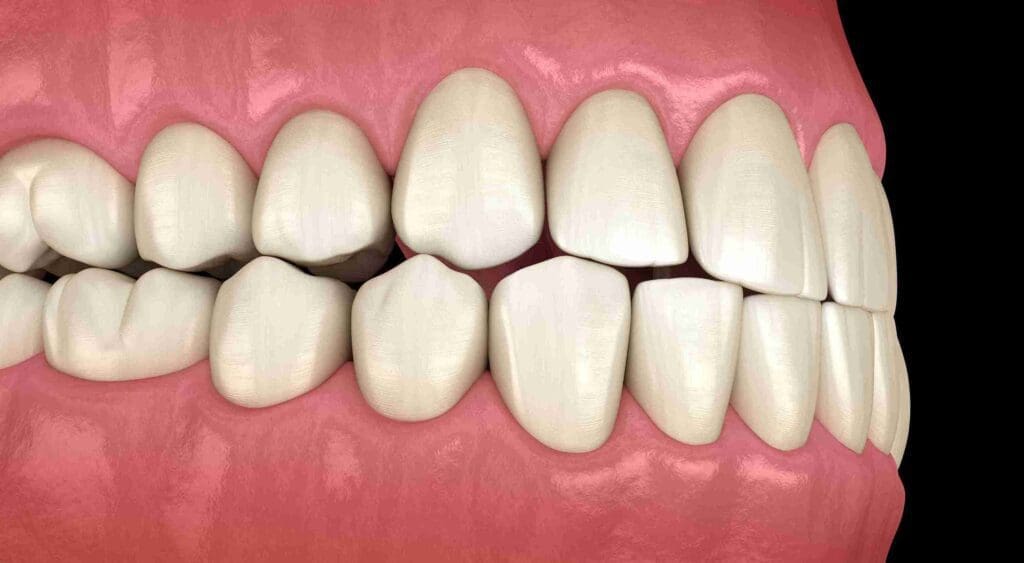 Professional illustration of a balanced dental bite after occlusal equilibration at Aghbashian Dental in Glendale, CA 91202, showing proper tooth alignment and jaw relief.