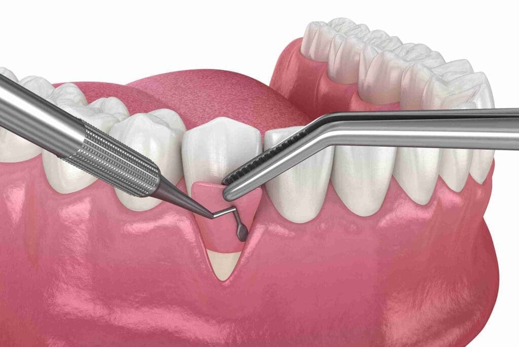 Professional periodontal gum surgery being performed at Aghbashian Dental in Glendale, CA 91202 to treat advanced gum disease and restore oral health.