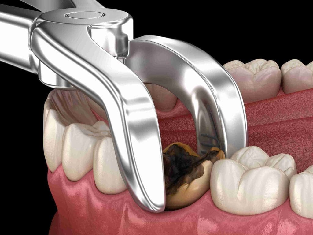Gentle tooth extraction procedure at Aghbashian Dental in Glendale, CA 91202, featuring high-tech dental equipment for a comfortable patient experience.